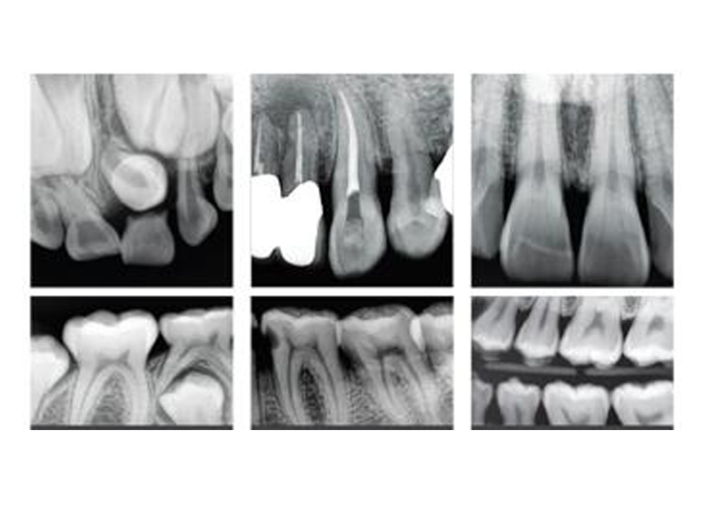 BL103 Portable Dental Xray